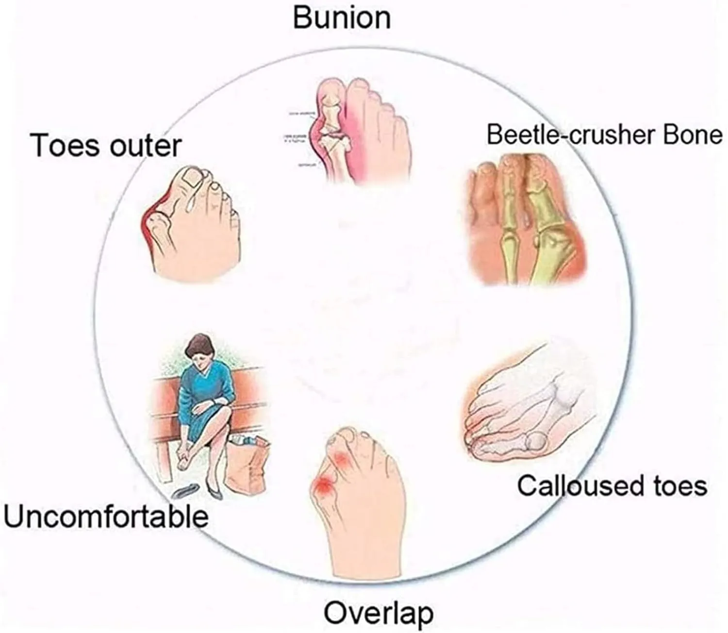 Women Comfy Sandal Big Toe Correction Sandal Orthopedic Bunion Corrector Summer Sandals PU Leather Platform Flat Sole Beach Shoes,Black,EU40/US8